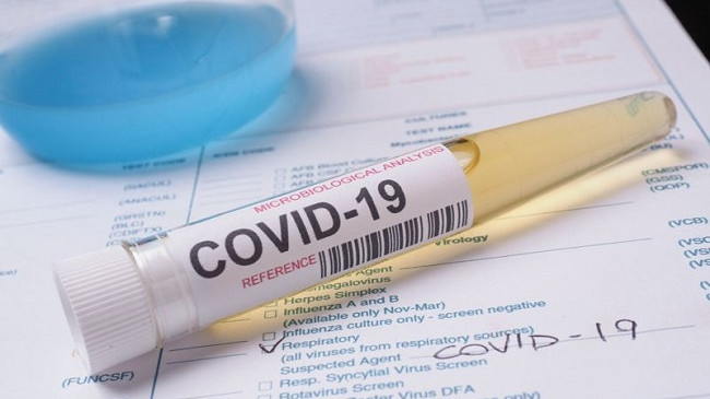 Pesë të shëruar dhe 36 raste të reja me koronavirus – shkon në 423 numri i të prekurve në Kosovë