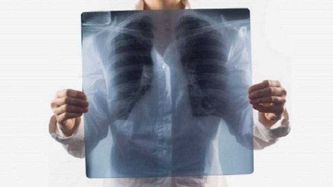 Pneumonia: Simptomat, shkaktarët dhe trajtimi